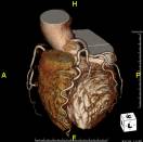 心臓の血管