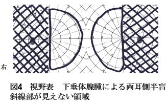 非機能性腺腫イメージ2
